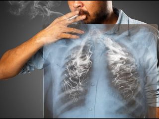Mengenal Kebiasaan Merokok: Pemicu Utama Kanker Paru-Paru