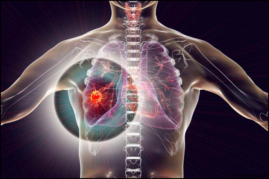 Kanker Paru-paru: Gejala, Penyebab, Diagnosis, dan Pengobatan